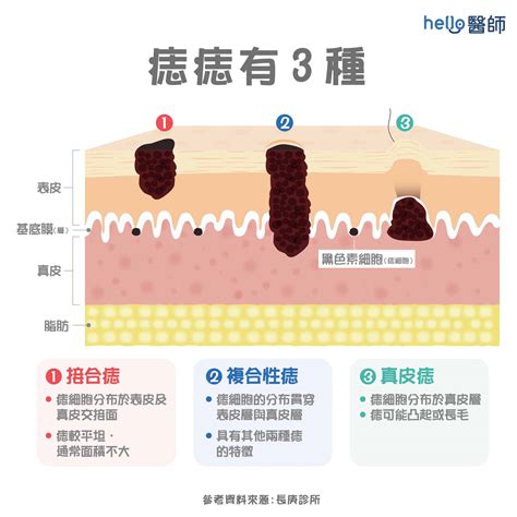 為什麼會長黑痣|痣形成的原因？痣長毛、痣變多變大是痣病變？5招判。